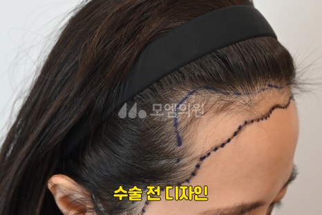 중앙헤어라인 이미지