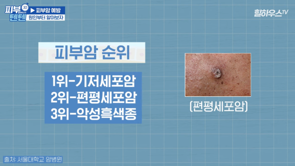 튀어나온 점, 피부암일까? 점 구별법, 점제거 치료 피부과 : 네이버 블로그