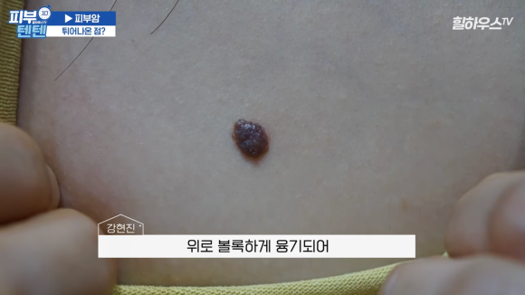 튀어나온 점, 피부암일까? 점 구별법, 점제거 치료 피부과 : 네이버 블로그