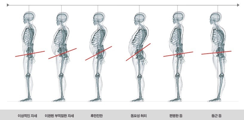 체형교정 이미지
