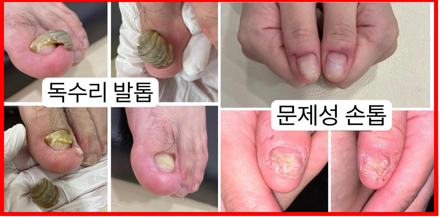내성발톱발톱무좀관리김수정뷰티 이미지
