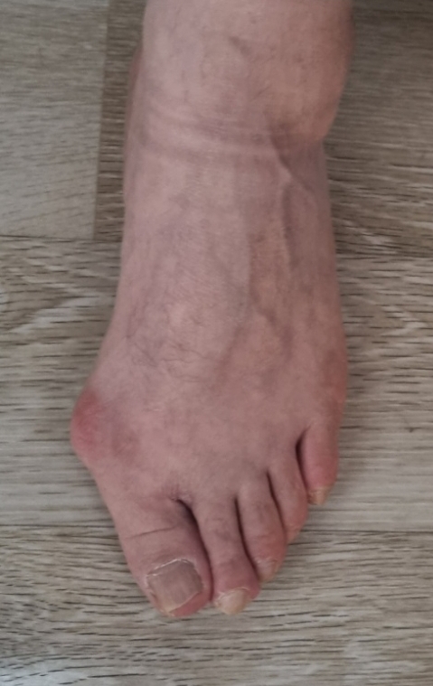 발테라피 이미지