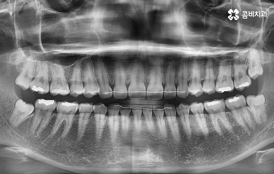 매복사랑니 냄새 방치하면 이런 문제도 생겨요 관련 이미지 1