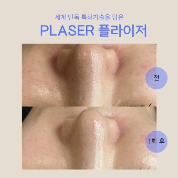 플라즈마 에스테틱 이미지