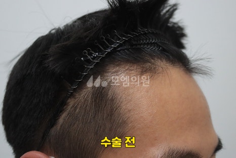 중앙헤어라인 이미지