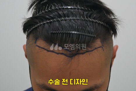 중앙헤어라인 이미지