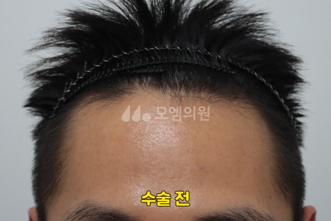 중앙헤어라인 이미지