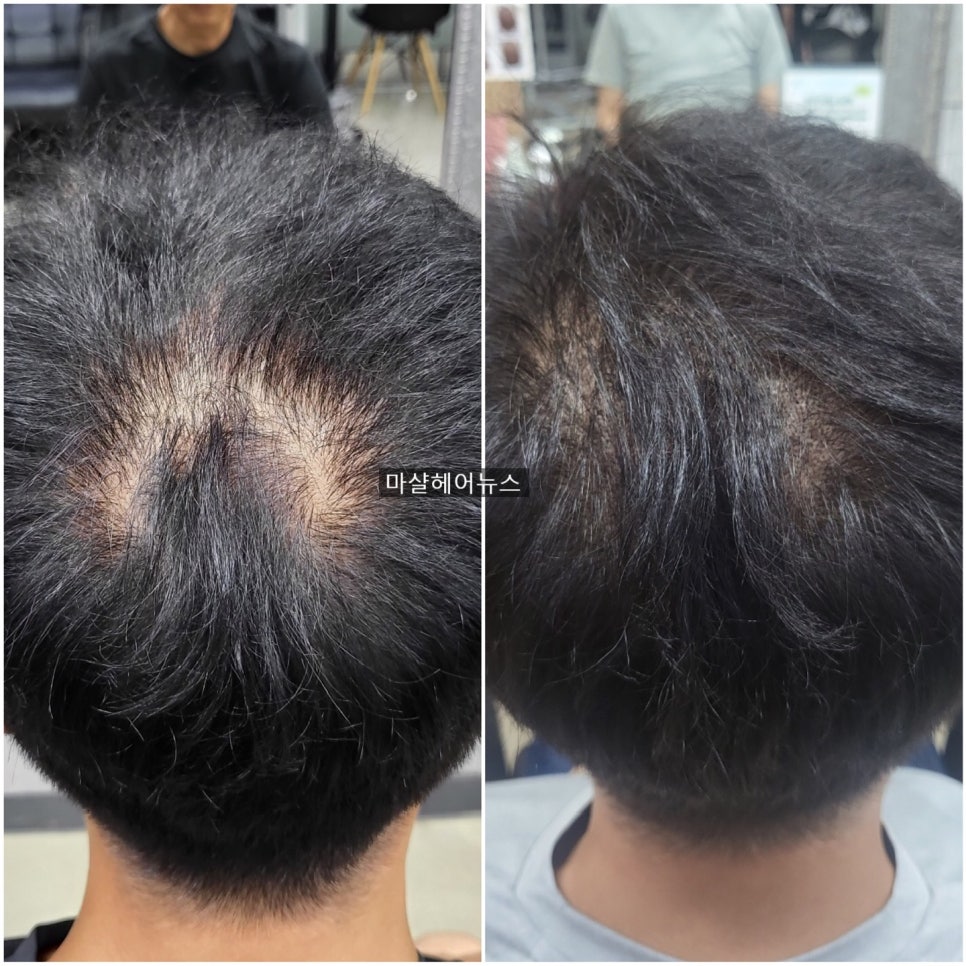 마샬헤어라인 이미지
