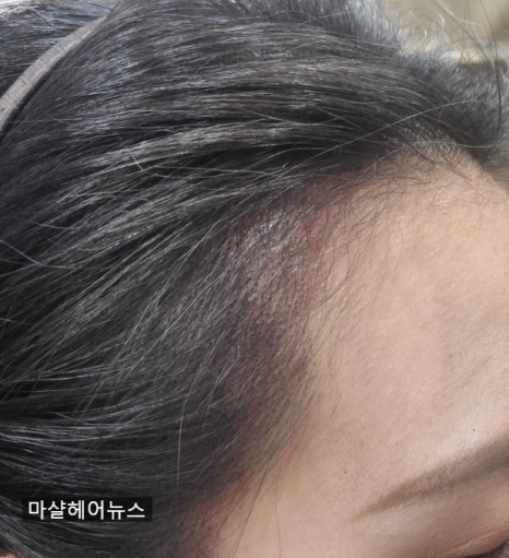 마샬헤어라인 이미지