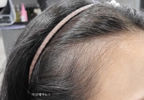 마샬헤어라인 이미지