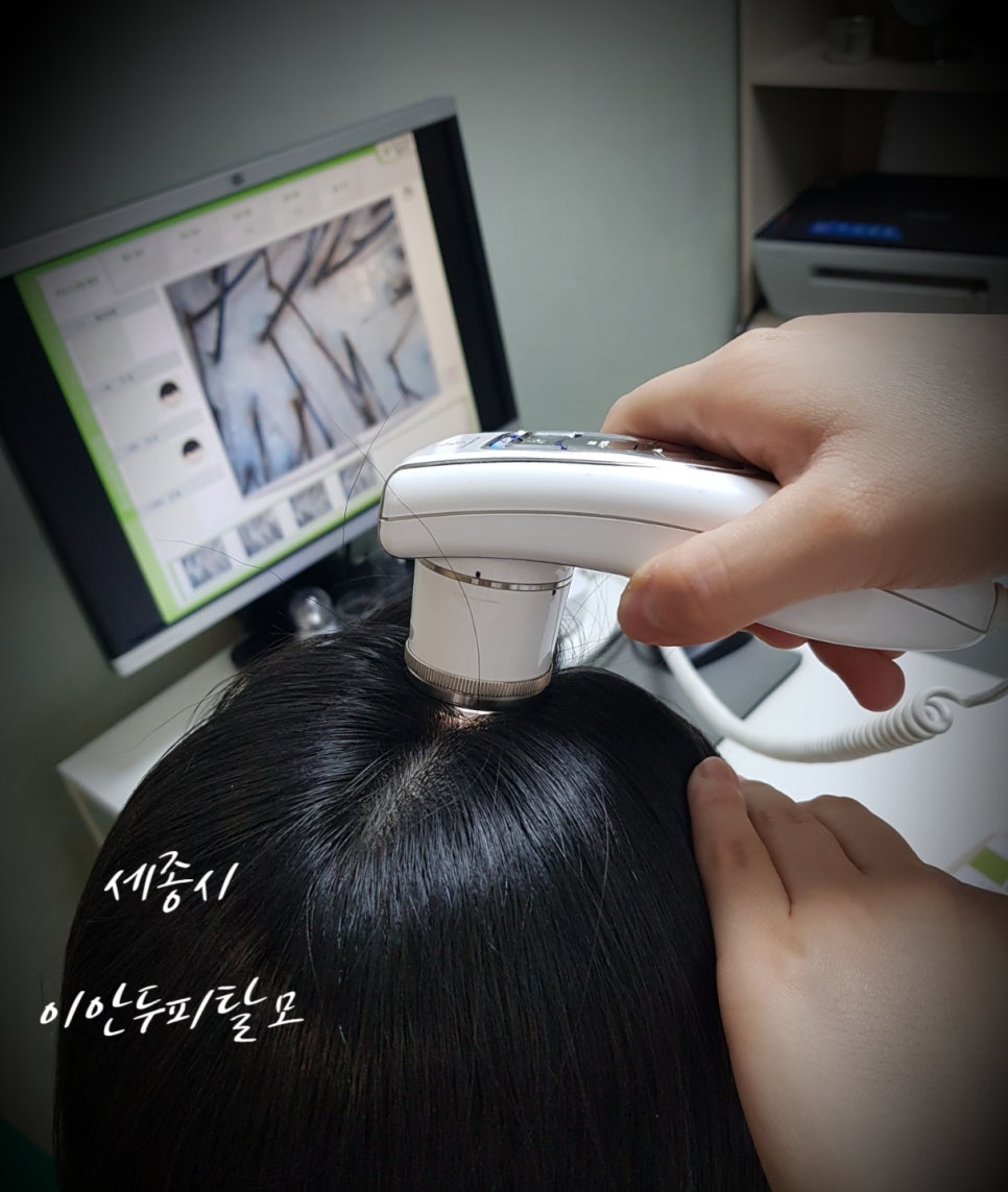 이안두피탈모 이미지