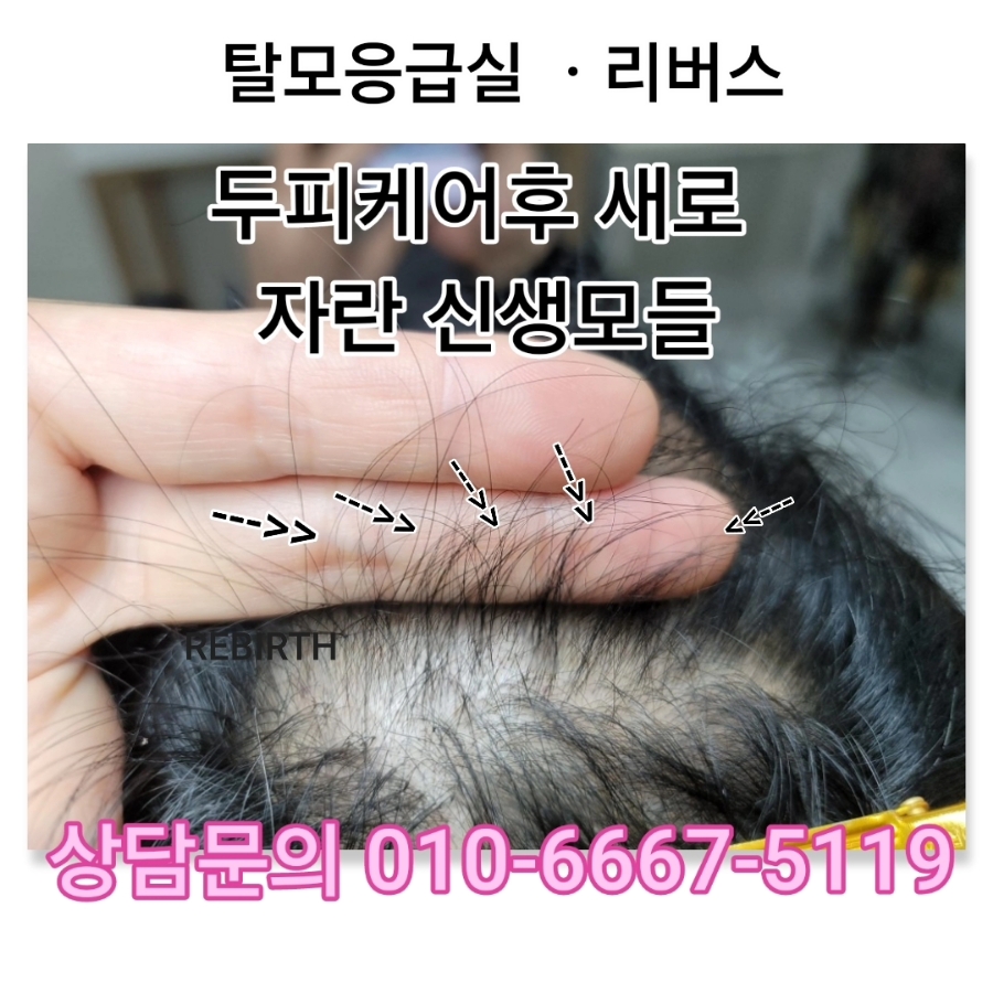 탈모응급실 리버스-다시태어나다 이미지