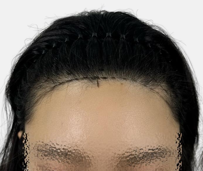 모모헤어라인 이미지