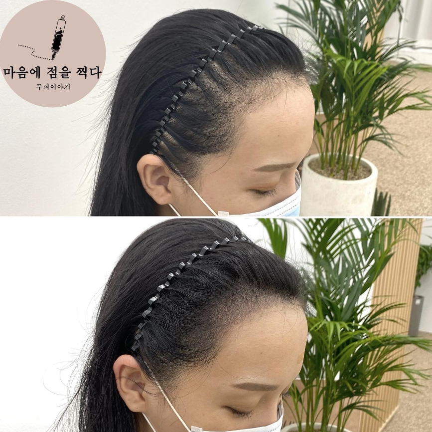 두피움 이미지