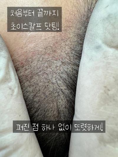 초이스칼프 이미지