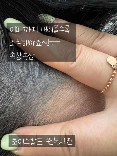 초이스칼프 이미지