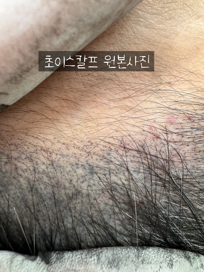 초이스칼프 이미지