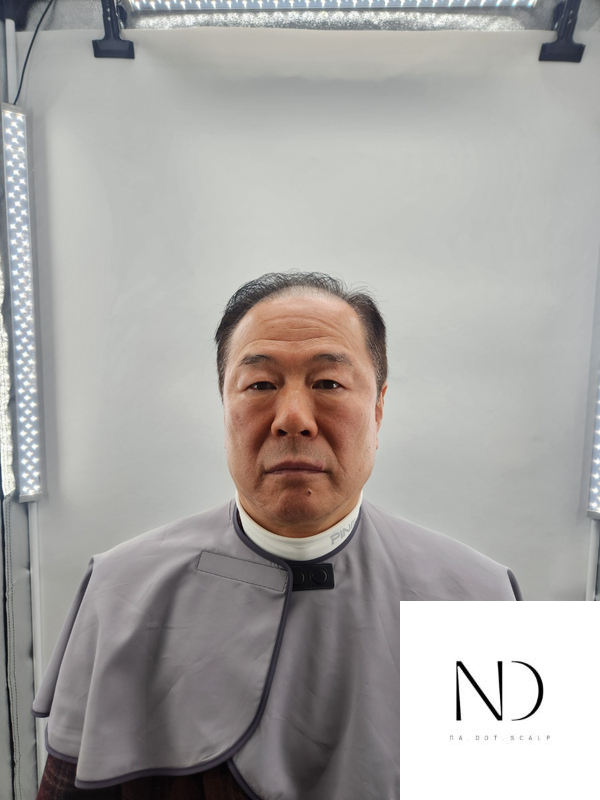 초이스칼프 이미지