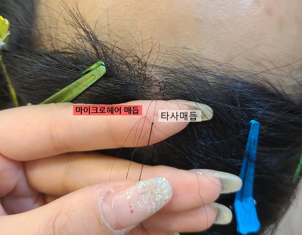 마이크로헤어증모 이미지