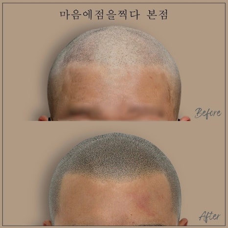 마음에점을찍다두피SMP 이미지