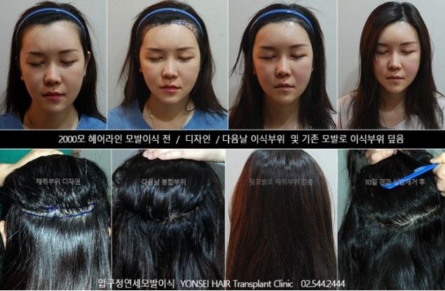 모발을 채우다 이미지
