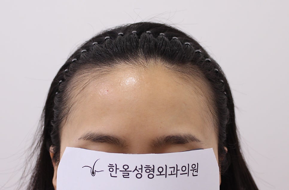 은혜헤어라인 이미지