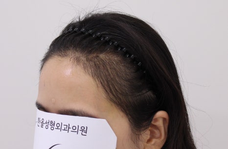 더헤어라인성형외과의원 이미지