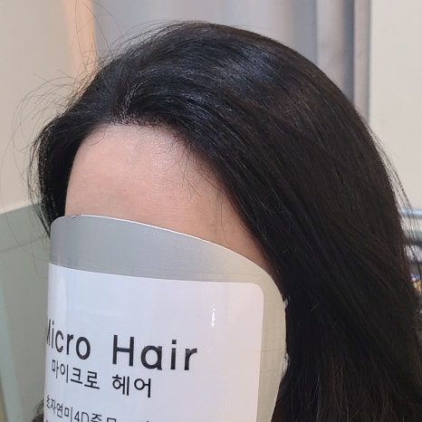 마이크로헤어증모 이미지