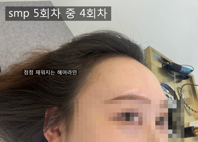루미아스칼프 이미지