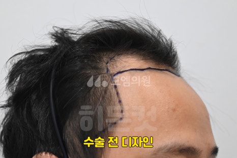 중앙헤어라인 이미지