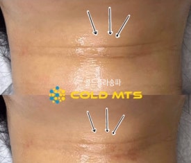 콜드 플라 송파 이미지