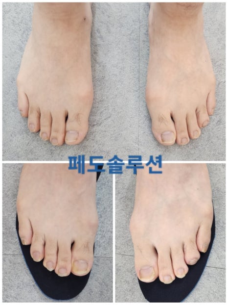 페도솔루션 이미지