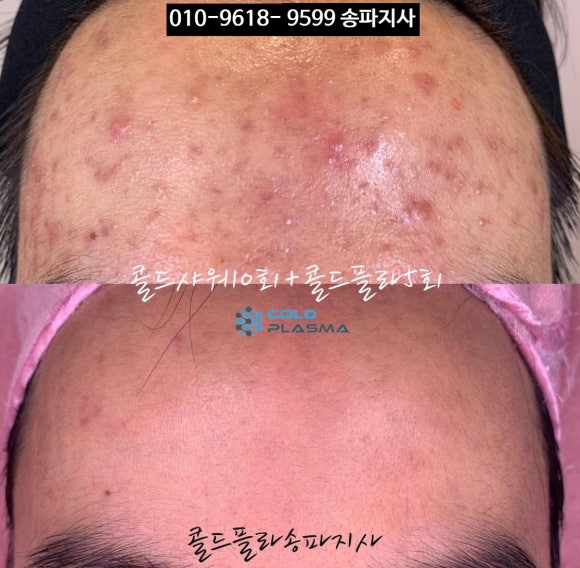 콜드 플라 송파 이미지