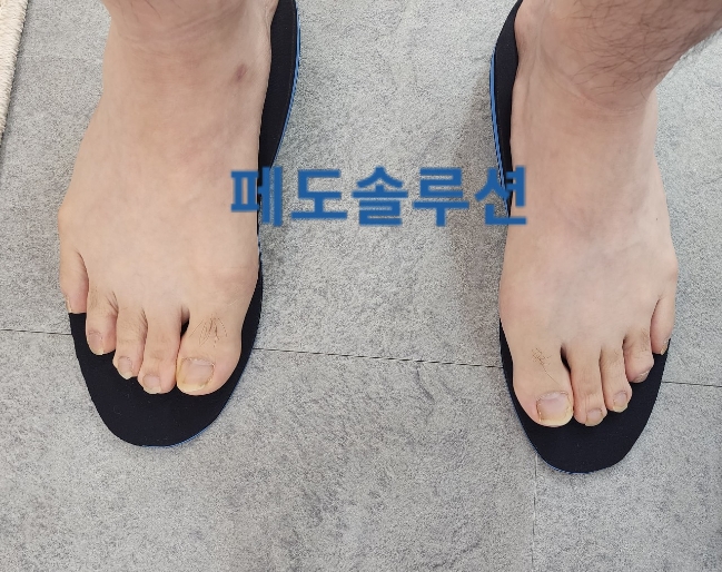 페도솔루션 이미지