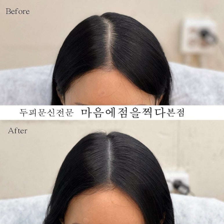 마음에점을찍다두피SMP 이미지