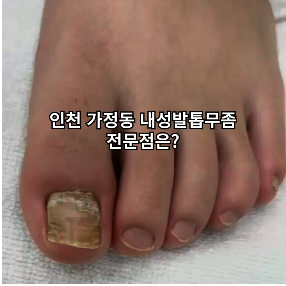 내성발톱발톱무좀관리김수정뷰티 이미지