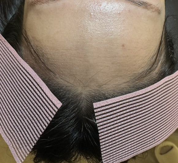 에이스 헤어라인 이미지