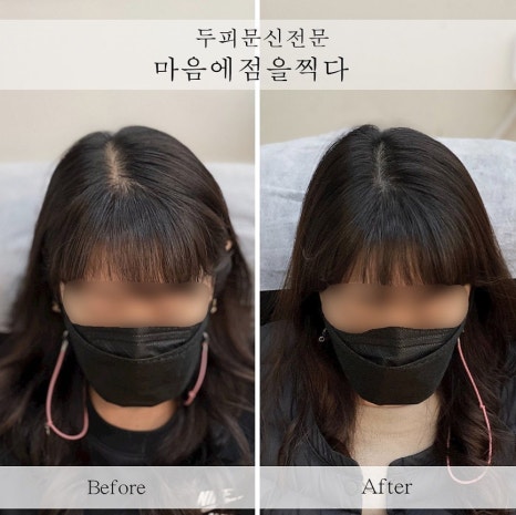마음에점을찍다두피SMP 이미지