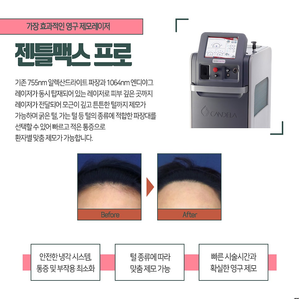 장헤어라인 이미지