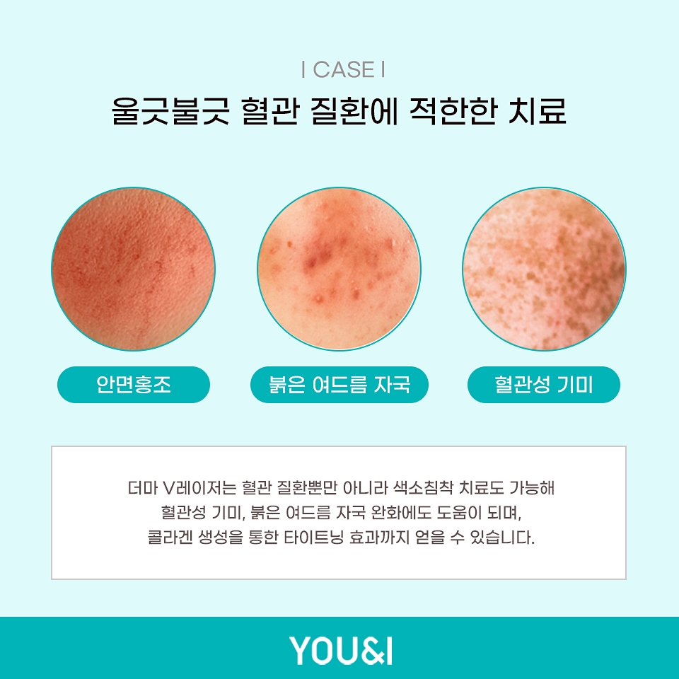 안면가스 이미지