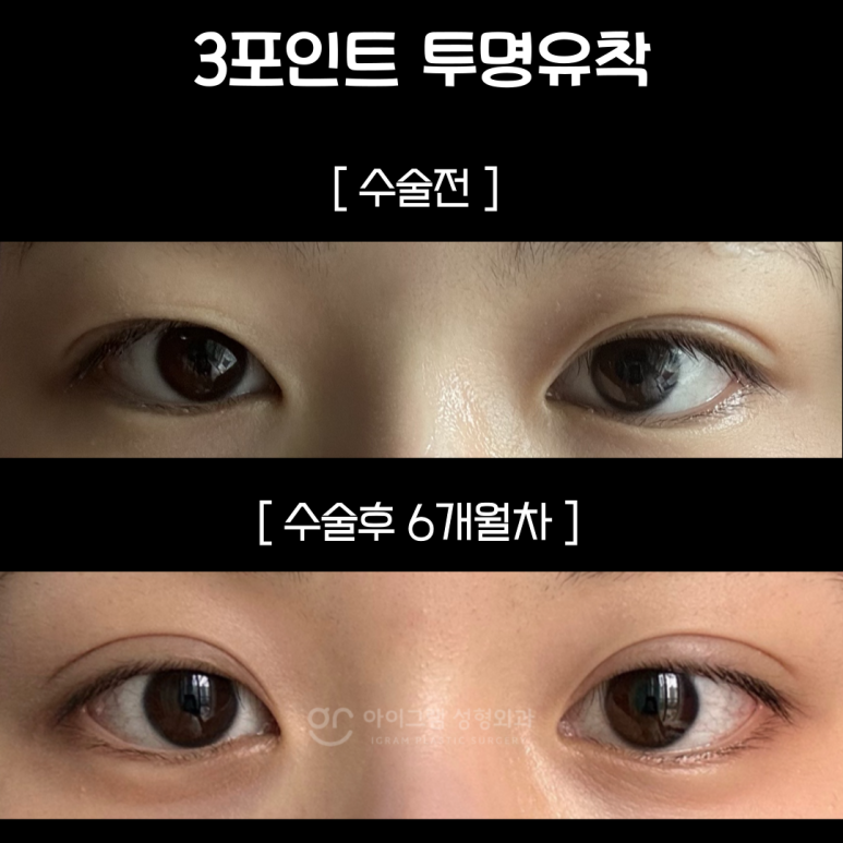 아이그램성형외과 이미지