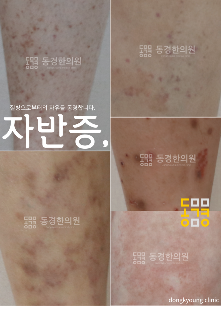 장기반점 이미지