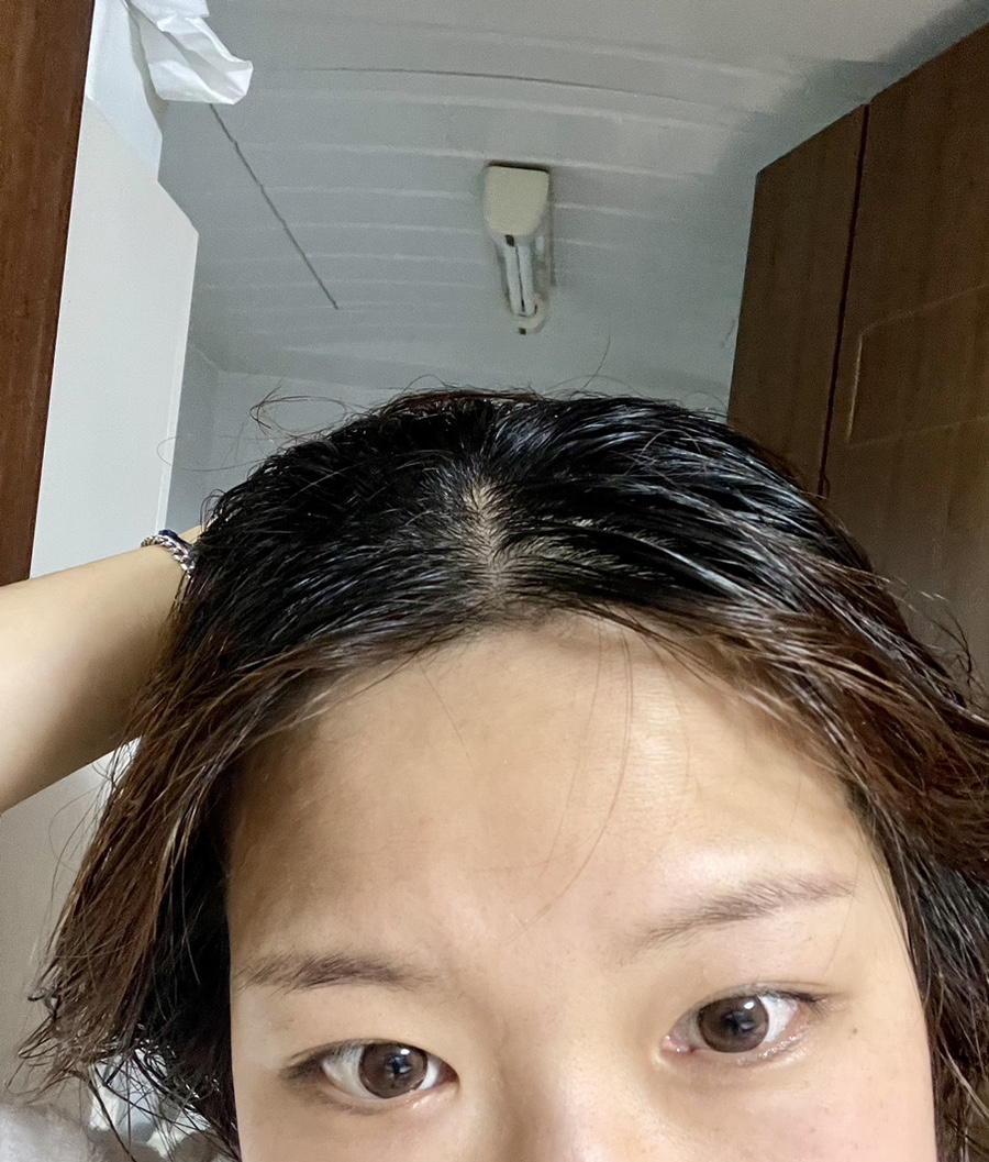 수두피케어 이미지