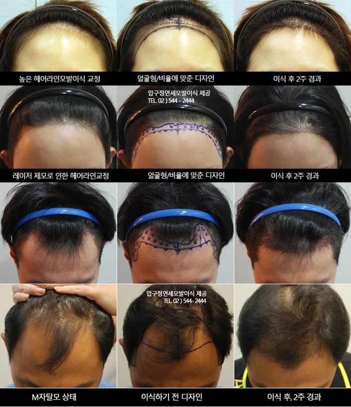 현헤어라인 이미지