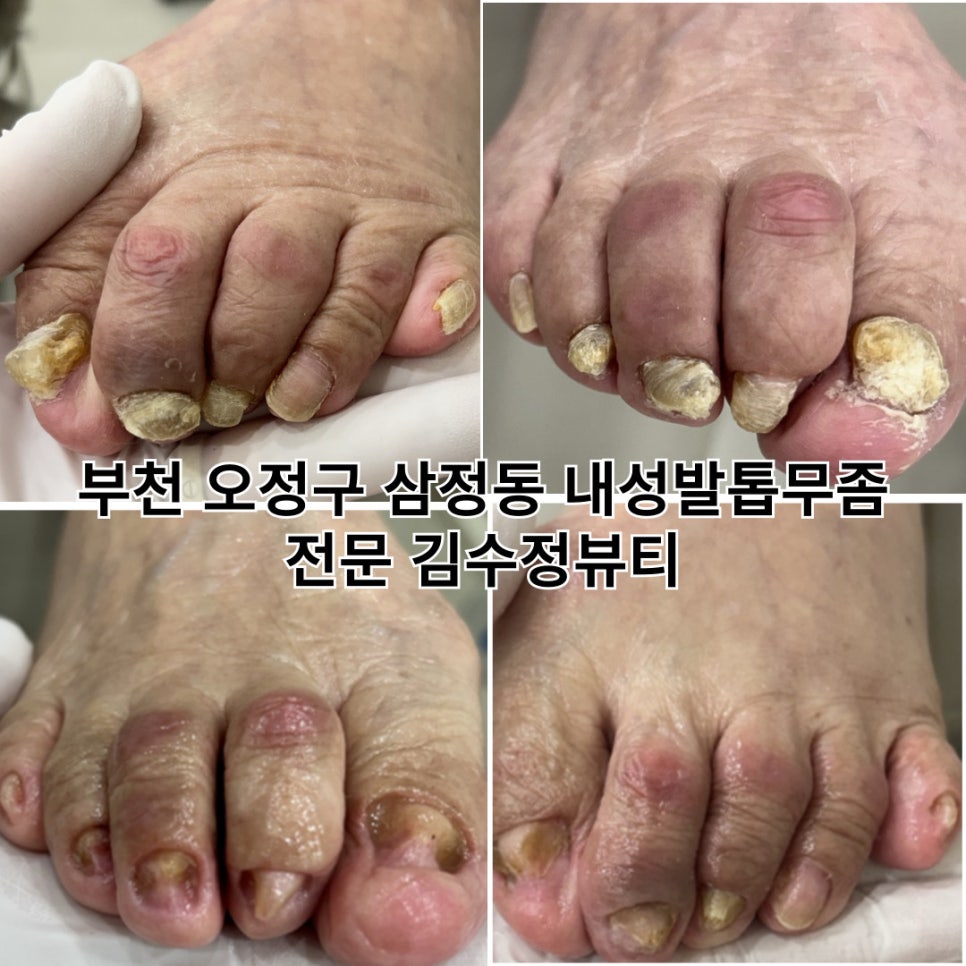 내성발톱발톱무좀관리김수정뷰티 이미지
