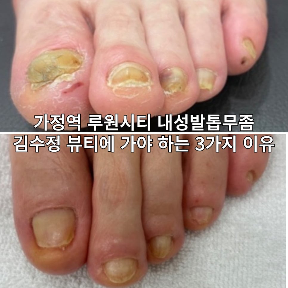 내성발톱발톱무좀관리김수정뷰티 이미지