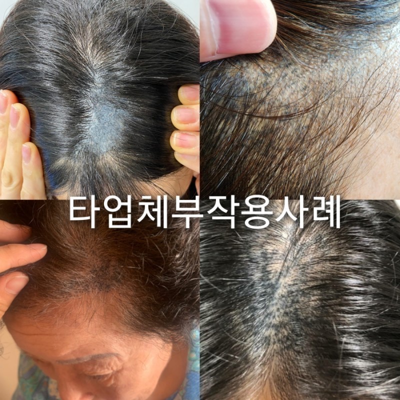 초지헤어라인 이미지