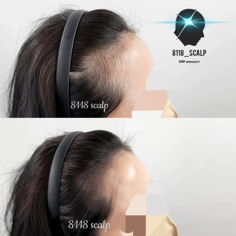 초지헤어라인 이미지