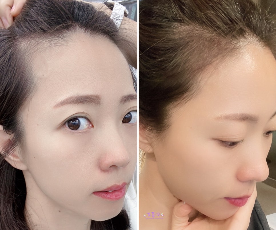 오즈헤어라인 이미지