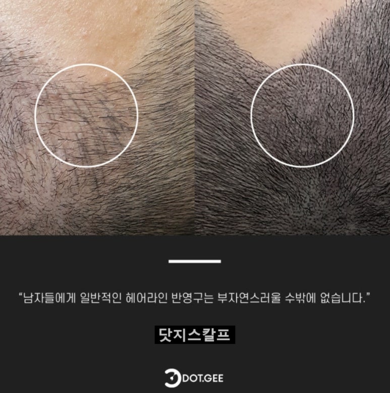 진헤어라인 이미지